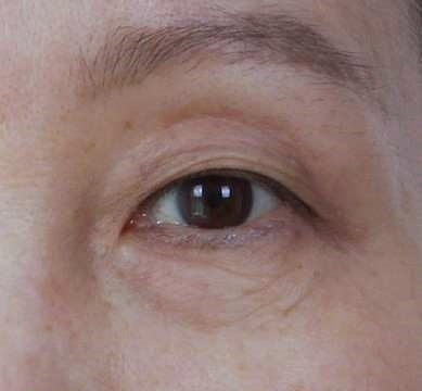 Mokdong Station Plastic Surgery: 3 Types of Surgery for Drooping Eyes (Upper Blepharoplasty / Brow Lift / Lower Blepharoplasty) image 1