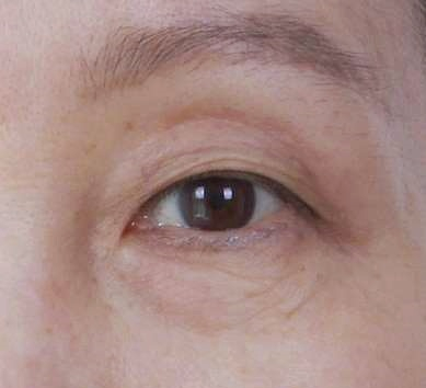 Recommended Types of Mokdong Middle-Aged Eye Surgery: 3 Surgery Options for Drooping Eyes image 1