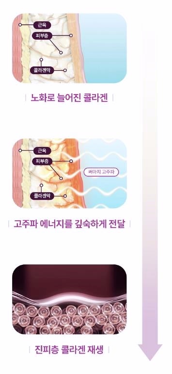 목동피부과 써마지 리프팅 600샷 효과 300샷 2배인가요? 관련 이미지 3