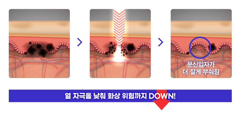 Eyebrow Tattoo Removal: What to Check If You’re Concerned About Discoloration, Blurring, or Scarring image 3