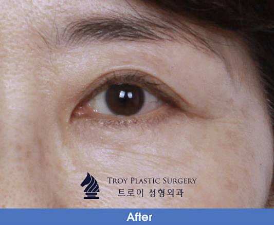 목동동안성형 어버이날 선물 추천 시/수술 3가지 관련 이미지 3