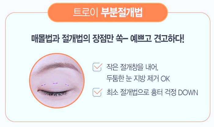 목동쌍수 매몰vs절개 방학때 하기 좋은 수술방법 따로 있나요? 관련 이미지 3