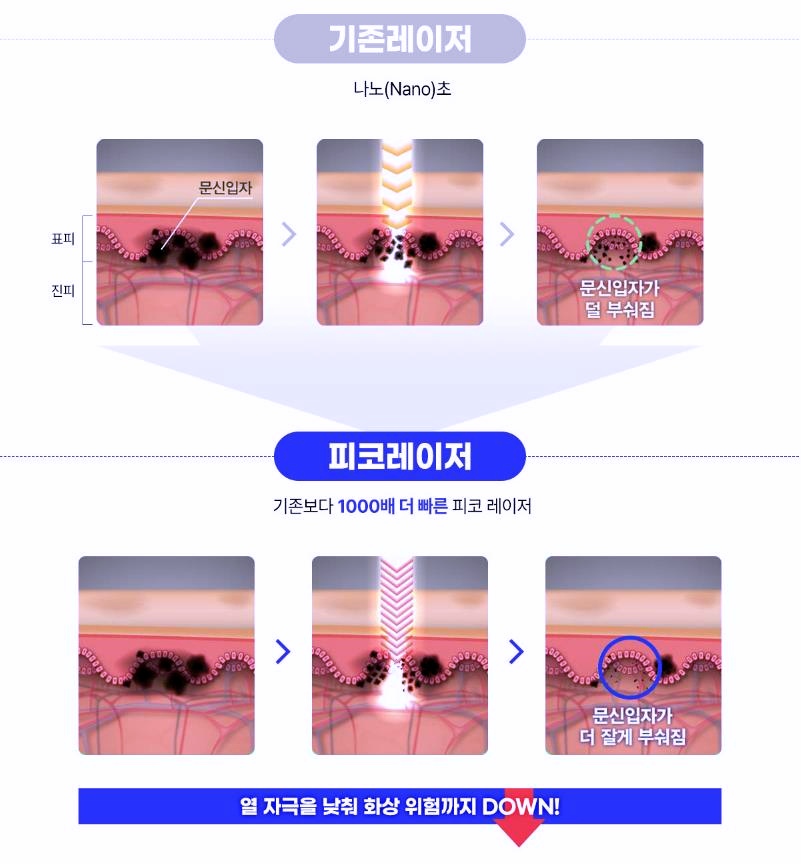 목동문신제거 통증 걱정되신다면 관련 이미지 2