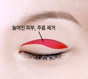 오목교역성형외과 중년쌍수 상안검 부작용 걱정? 이걸로 끝 관련 이미지 1