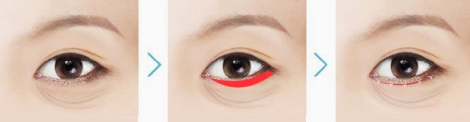 목동하안검 눈밑살처짐 고민에 좋은 이유 관련 이미지 2