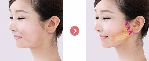 강서구안면거상술 성형외과 전문의가 맞춤진료 하는 곳 관련 이미지 1
