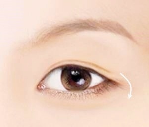목동 눈매교정 남자 안검하수 가장 중요한 관련 이미지 1