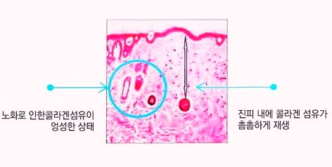 목동실리프팅 제대로 효과 보고 싶다면 &lsquo;이것&rsquo; 꼭 확인하세요 관련 이미지 3
