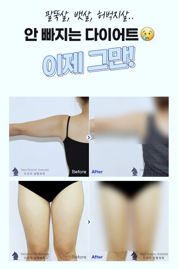목동역지방분해주사 운동 없이 다이어트 성공 가능? 관련 이미지 5