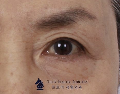 목동눈썹거상 수술 흉터 걱정을 덜 수 있는 곳 관련 이미지 3