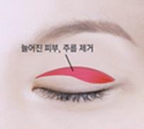 목동상안검, 처진 눈 관련 이미지 1