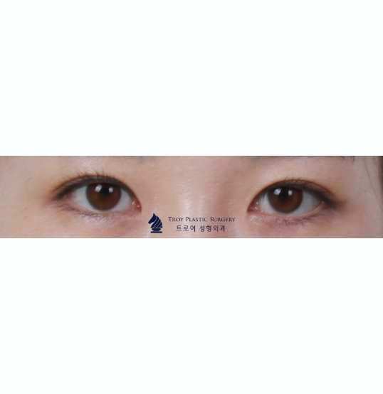 목동앞트임? 뒤트임? 가로 눈 길이 짧을 때 필요한 수술은? 관련 이미지 1