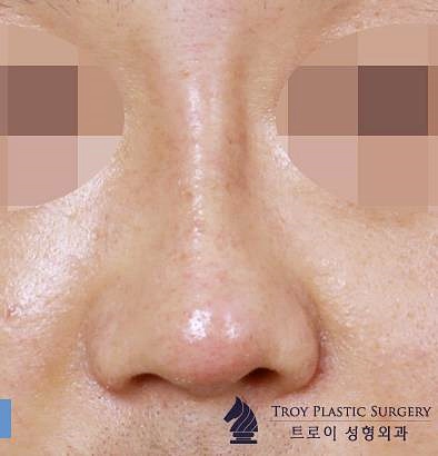 목동필러 잘하는 곳 찾는다면 관련 이미지 3