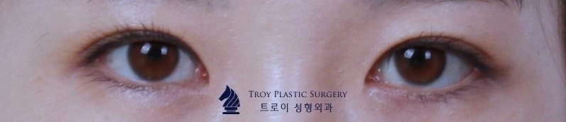 김포쌍꺼풀수술 돌출눈/함몰눈 이렇게 해야 성공합니다 관련 이미지 6