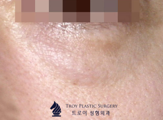 눈밑지방재배치, 이런 경우에는 효과가 제한적일 수 있습니다 관련 이미지 4