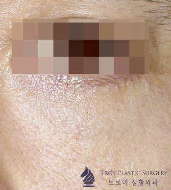양천구성형외과 눈밑하안검수술 부작용 걱정되는 분들은 보세요 관련 이미지 4