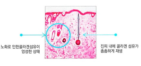 목동리프팅 성형외과 전문의 추천 3가지 솔루션 관련 이미지 4