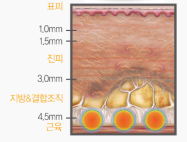 목동포텐자, 모공&middot;탄력&middot;흉터를 한 번에 잡는 이유 관련 이미지 9