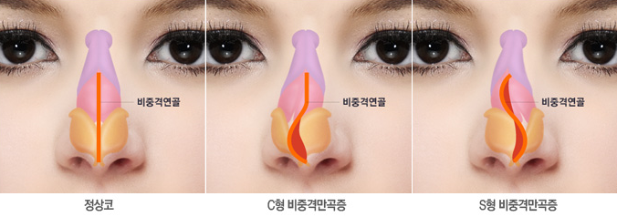 [목동트로이성형외과] 휜코교정 휜코수술 방법 알아보기! 관련 이미지 1
