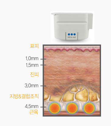 목동울쎄라 수술 없이 얼굴 처짐 고민 해결했어요 관련 이미지 5