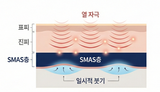 목동리프팅 후 붓기, 언제까지 정상으로 봐야 할까요? 관련 이미지 3