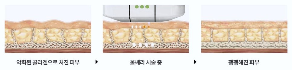 강서구울쎄라 잃어버린 피부탄력을 회복시켜보세요 관련 이미지 3