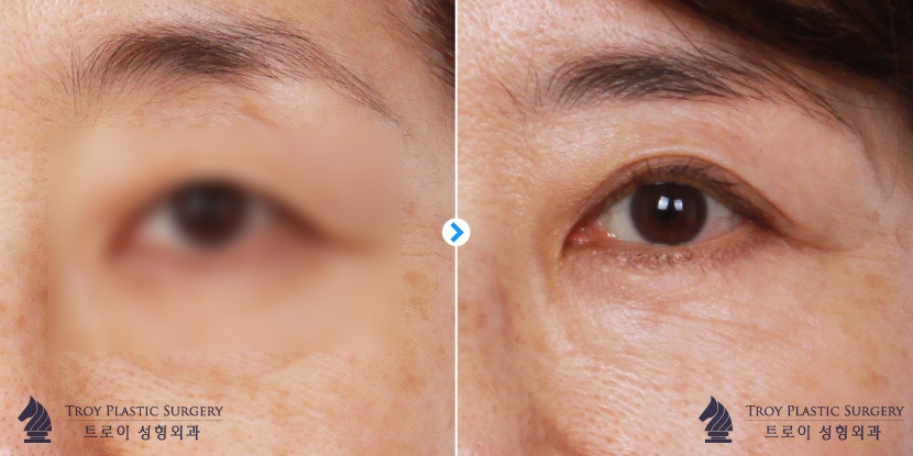 강서구 하안검부작용 안검외반 예방하는 2가지 방법 관련 이미지 2