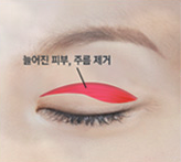 강서구눈성형 상안검 하안검으로 부모님께 효도하기 관련 이미지 2
