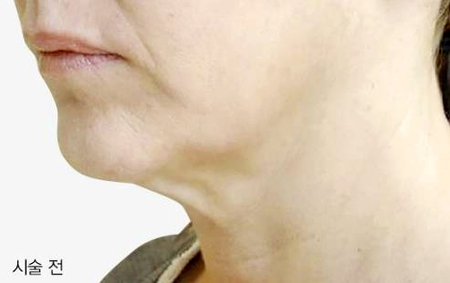 양천구피부과 인모드 ○○○○ 안 지키면 효과 보기 어렵습니다 관련 이미지 5