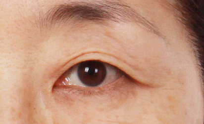 Mokdong Upper Blepharoplasty image 2