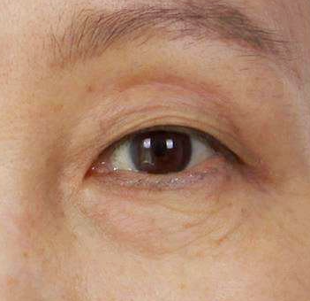 Mokdong Lower Blepharoplasty Surgery: Worried About Ectropion Side Effects? image 3