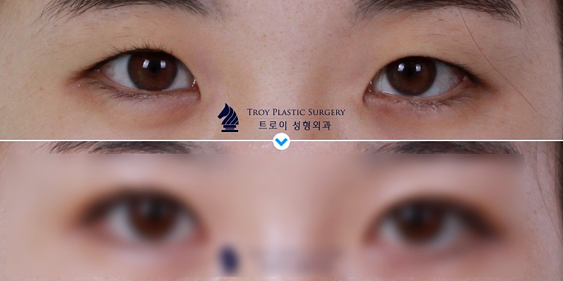 목동 눈성형 가격 겨울 한정 이벤트 모음 (트임성형/눈매교정/눈썹밑거상술/상안검/하안검) 관련 이미지 3