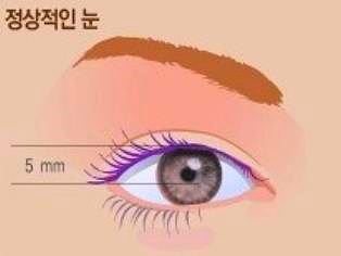 목동눈매교정 잘하는 곳 이것 2가지 꼭 확인하세요 관련 이미지 2