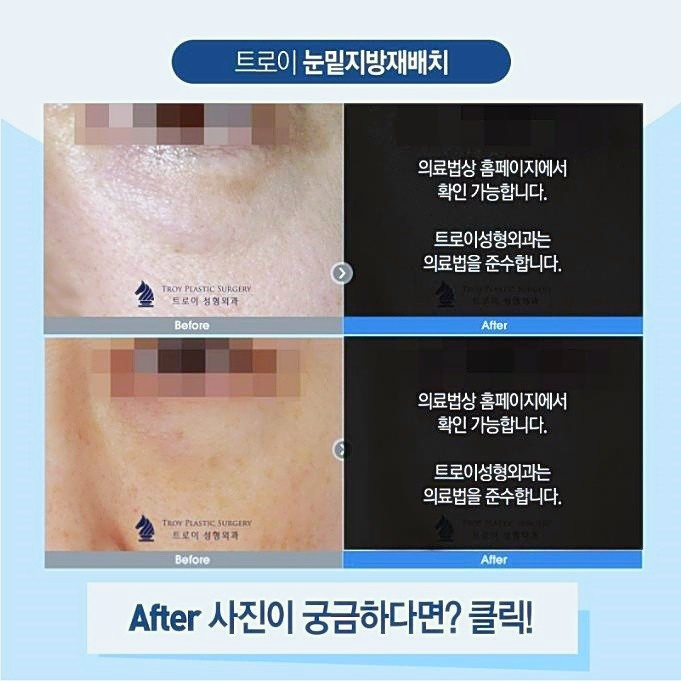 목동눈밑지방재배치 심한 다크서클과 볼록살이 고민이신분들 보세요 관련 이미지 2