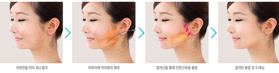 목동리프팅 성형외과 전문의 추천 3가지 솔루션 관련 이미지 5