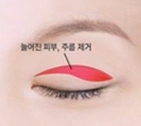 Mokdong Upper Blepharoplasty image 1