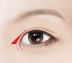 Gimpo Eye Surgery: How to Reduce the Horizontal Length of the Eyes with Inner and Outer Corner Surgery image 1