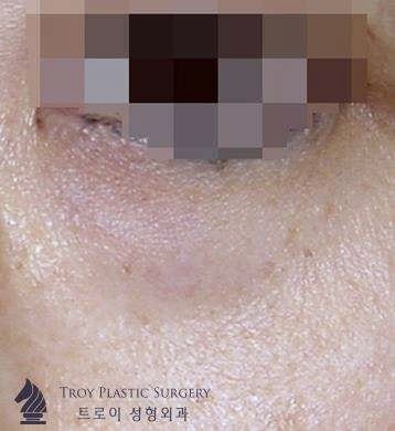 목동 눈밑지방재배치 잘하는 곳 특징 2가지? 관련 이미지 2