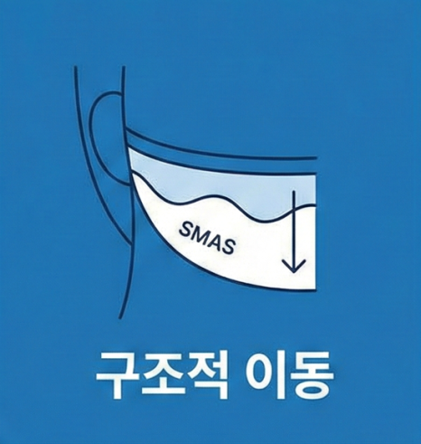 목동 안면거상, 리프팅으로 더 이상 버티기 어려운 신호들 관련 이미지 6