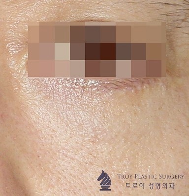 목동성형외과 추천 중년눈성형 3가지 관련 이미지 6