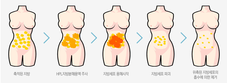 [목동HPL] 매끈한 허벅지 완성하는 지방분해주사 허벅지HPL 관련 이미지 2