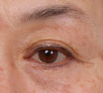 Gimpo Plastic Surgery: Upper Blepharoplasty or Eyebrow Lift? Which Droopy Eye Surgery Is Right for Me? image 4