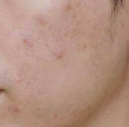 목동피부과 10년 경력 의사가 추천하는 000? 관련 이미지 3