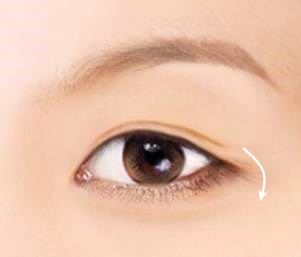 목동눈매교정 잘하는 곳 이것 2가지 꼭 확인하세요 관련 이미지 1
