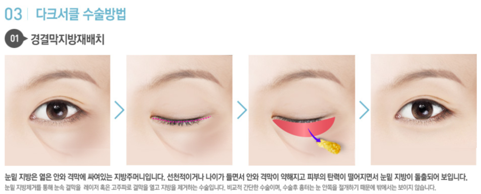 목동눈밑지, 다크서클 때문에 고민이라면 먼저 확인할 것 관련 이미지 5