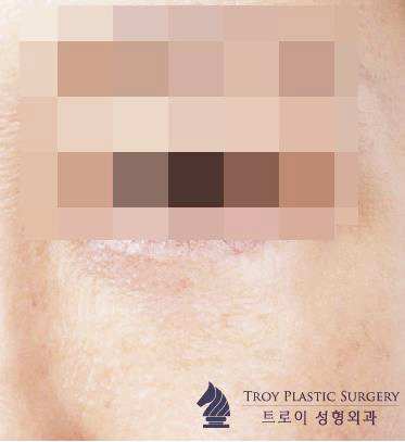 양천구성형외과 눈밑하안검수술 부작용 걱정되는 분들은 보세요 관련 이미지 5