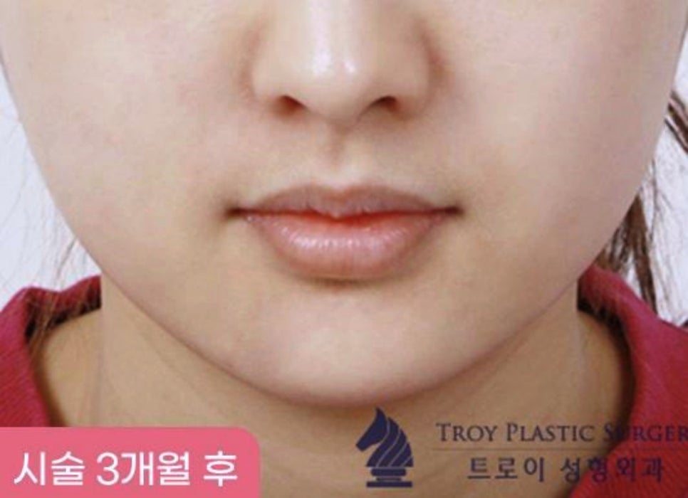 목동역성형외과 잘 고르는 핵심 알려드립니다 관련 이미지 4