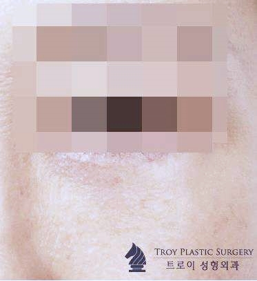 김포하안검 안검외반 부작용 무조건 생기는 건가요? 관련 이미지 5