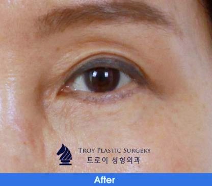 김포성형외과 잘하는 곳 찾다가 목동까지 가는 이유 관련 이미지 2