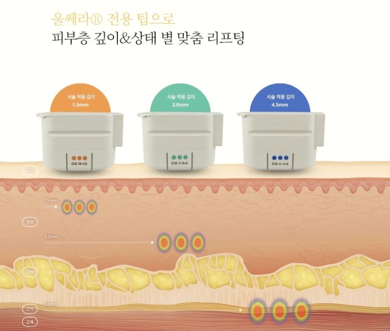 How to Avoid Wasting Money on Mok-dong Ulthera Lifting image 1